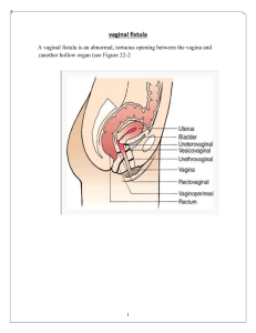 vaginal fistula