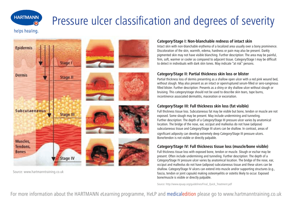 Turning Chart Pressure Ulcer
