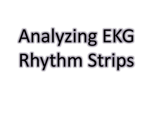 Analyzing EKG Rhythm Strips
