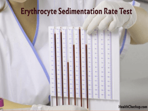 ERYTHROCYTE SEDIMENTATION RATE