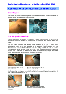 Radio Surgical Treatments with the radioSURG® 2200 Removal of a