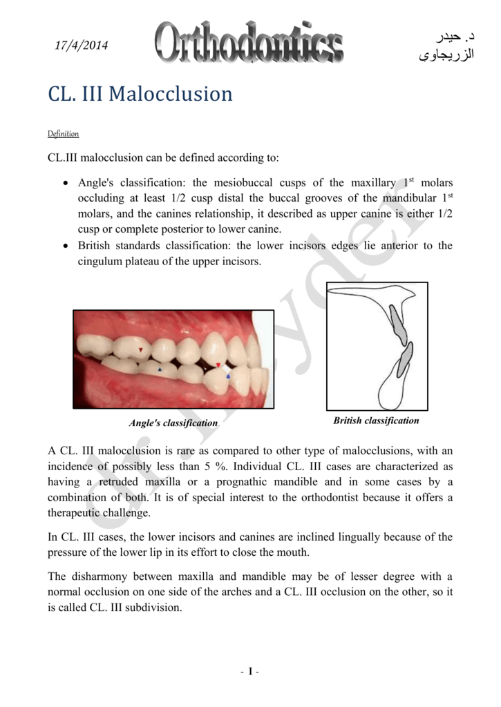 Class Iii Malocclusion Definition