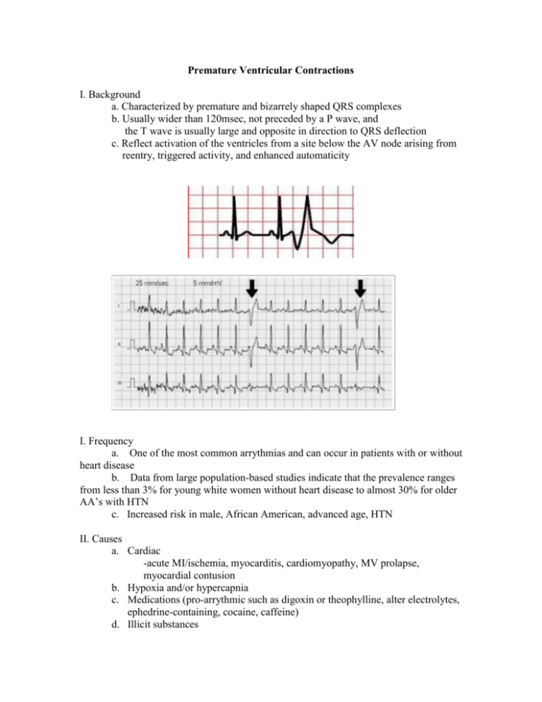 Premature Ventricular Contractions Types