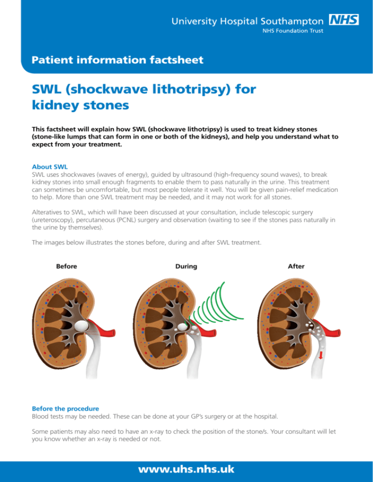 Swl Shockwave Lithotripsy For Kidney Stones