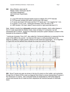 002 Sinus Rhythm, atrial rate 90 Mobitz II AVB, Ventricular rate 50