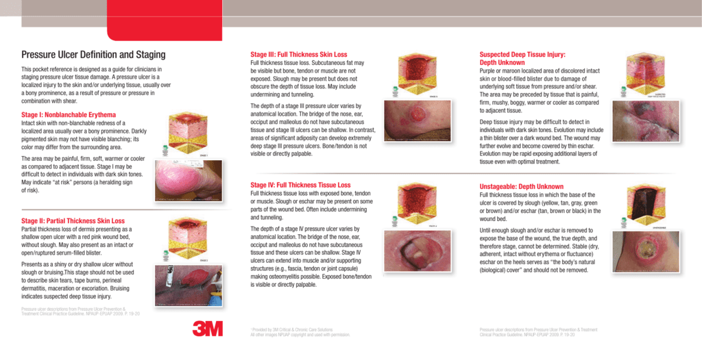 Pressure Ulcer Staging Chart