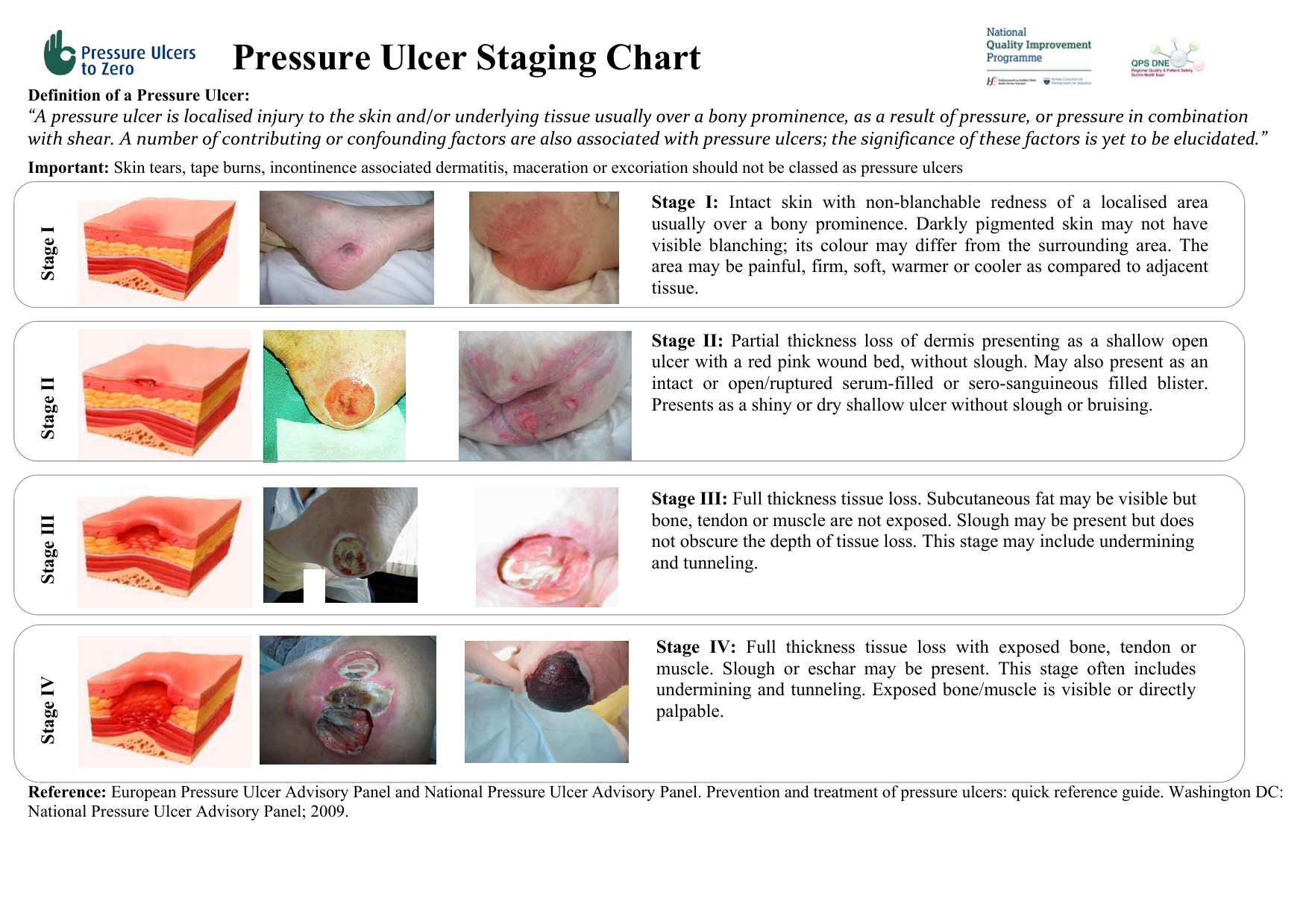 What level is a pressure wound?