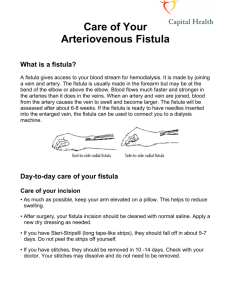Care of Your Arteriovenous Fistula What is a fistula?