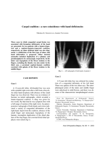 Carpal coalition : a rare coincidence with hand deficiencies