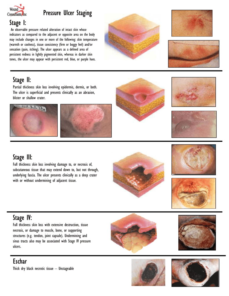 Pressure Ulcer Staging Chart