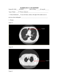 DI-Chest-lung Nodule