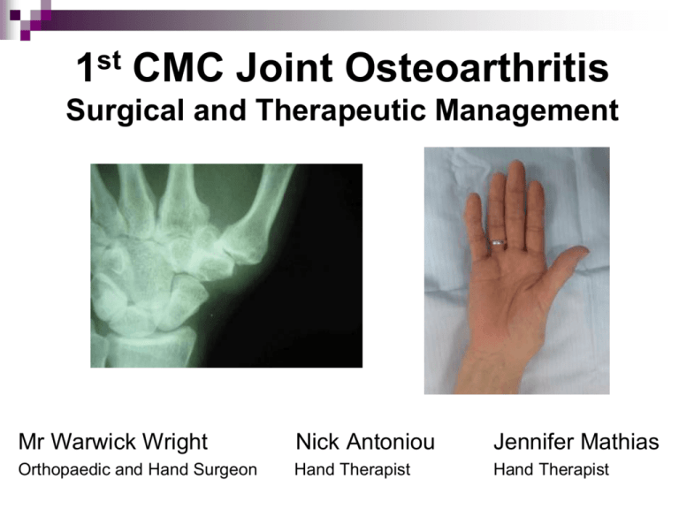 1st Cmc Joint Osteoarthritis 8708