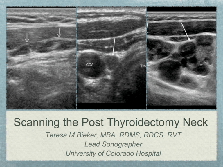 scanning-the-post-thyroidectomy-neck