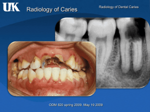 Radiographic interpretation of Caries (5-19-09)