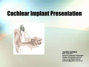 Cochlear Implant Presentation