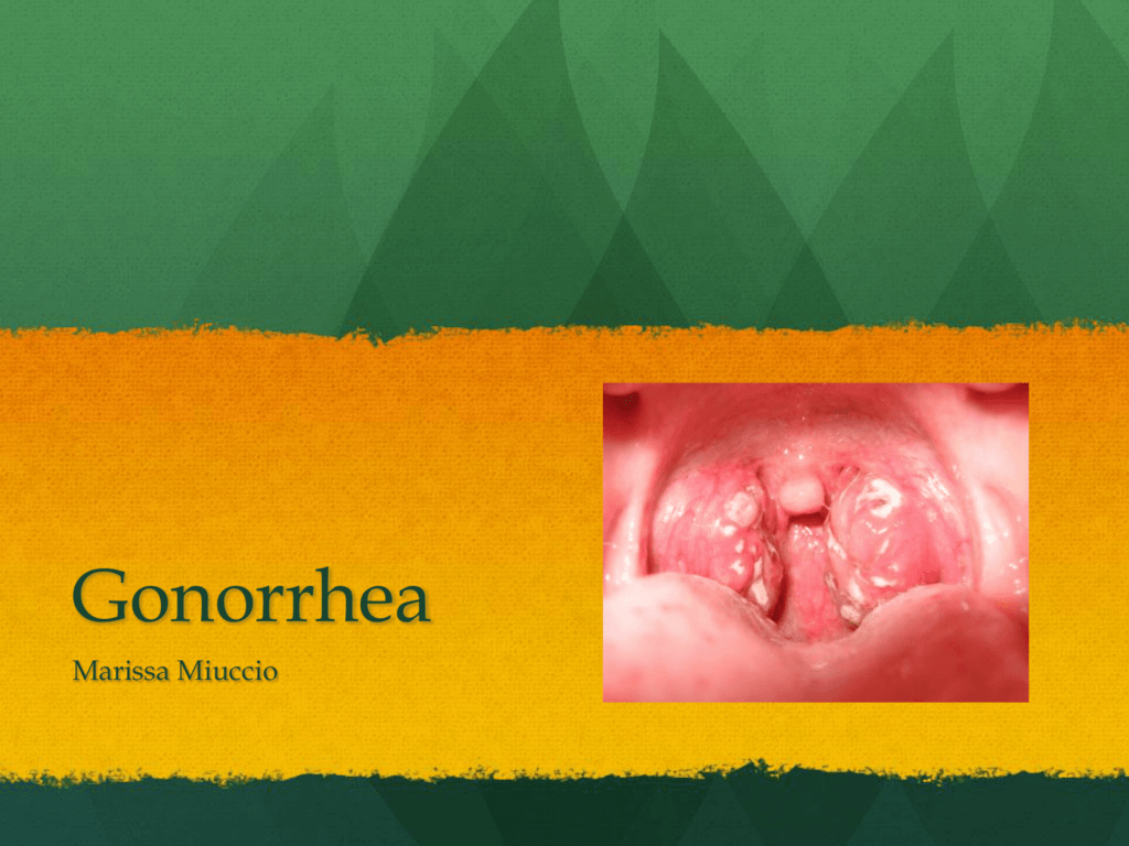gonorrhea symptoms in the throat