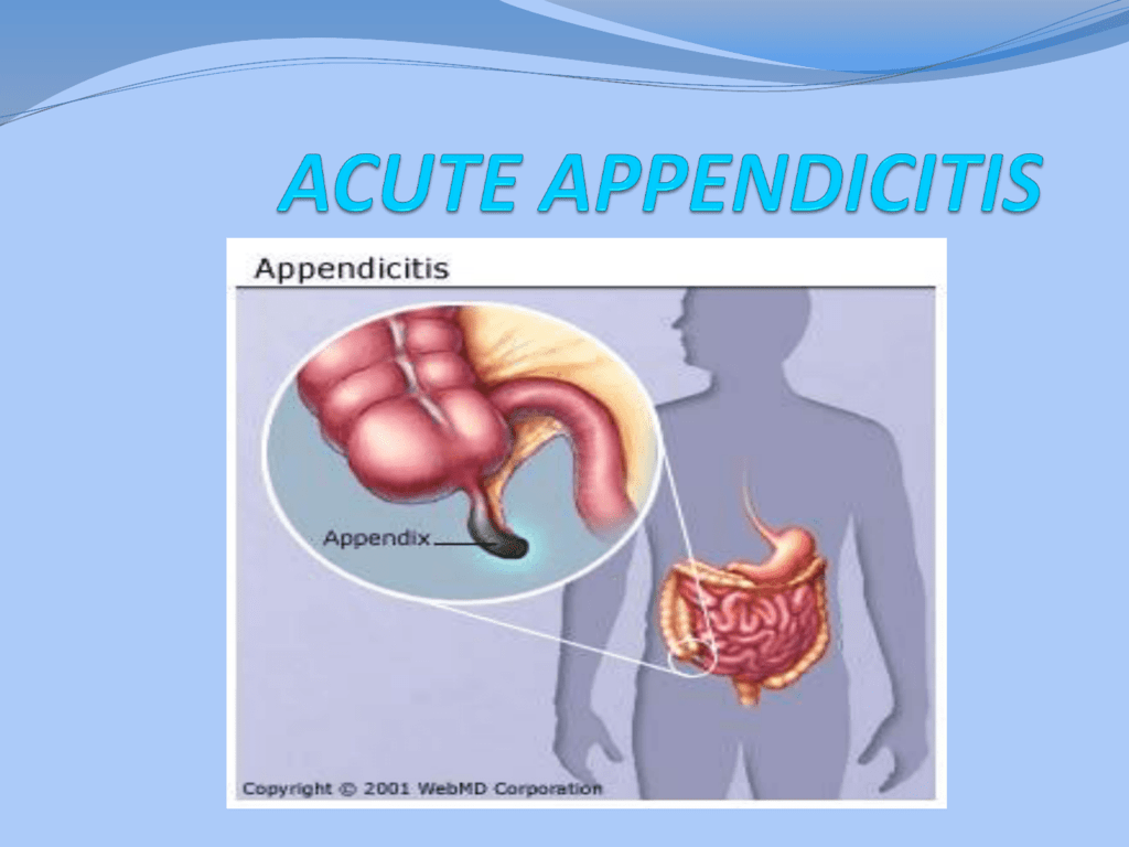 appendicitis related thesis