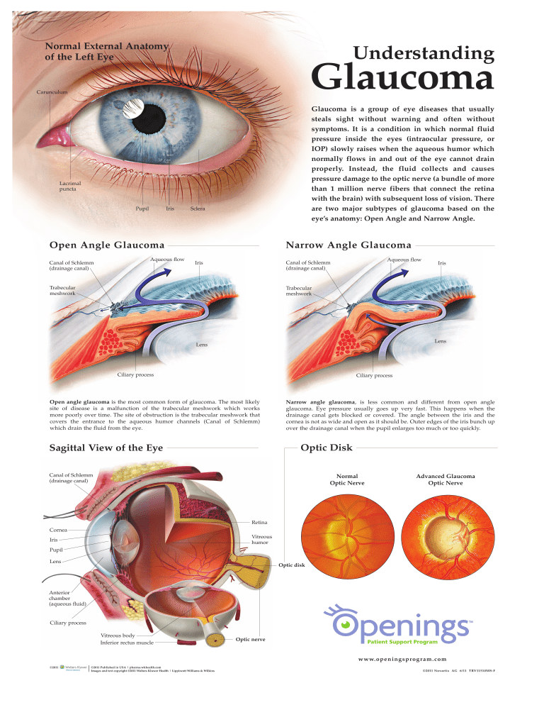 alcon glaucoma
