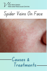 Spider Veins on Your Face: Causes and Treatment